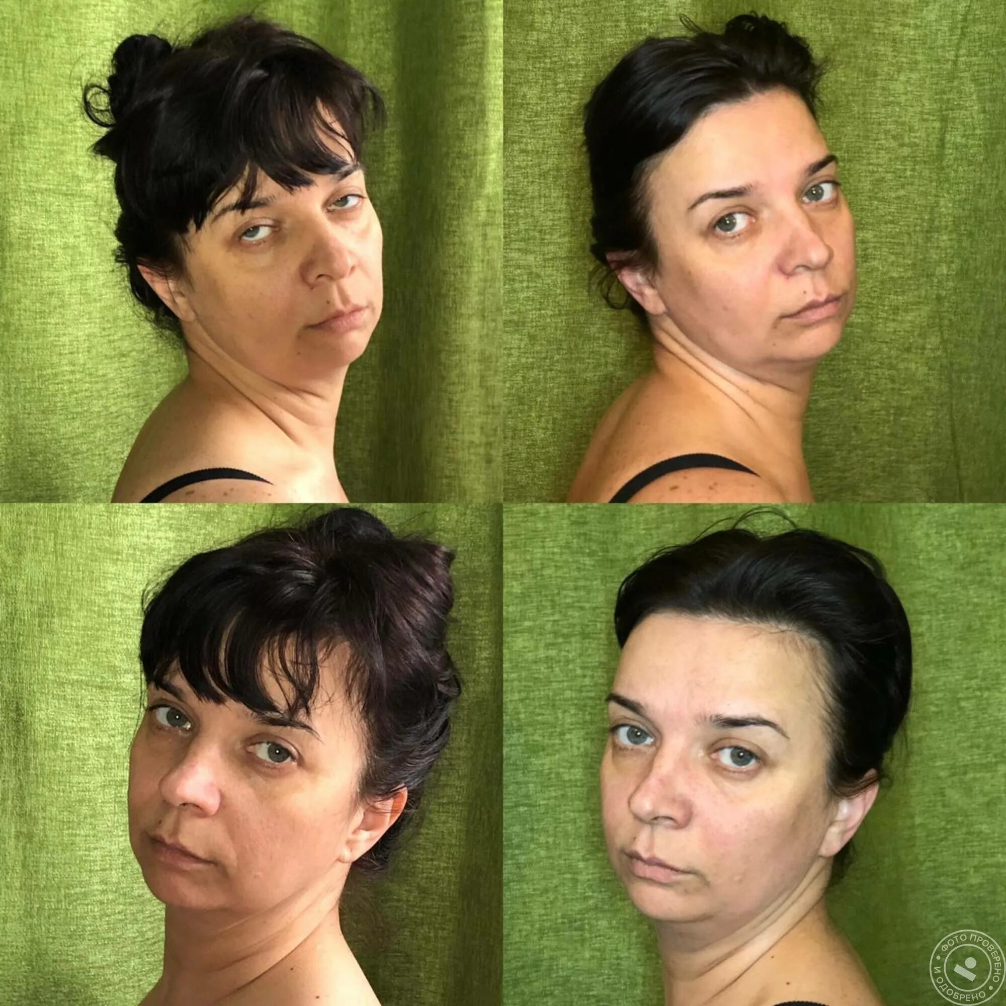Миофасциальный массаж лица фото до и после Миофасциальный массаж лица: техника выполнения, отзывы