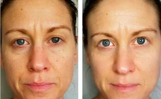 Миофасциальный массаж лица фото до и после Уходы Dr schrammek