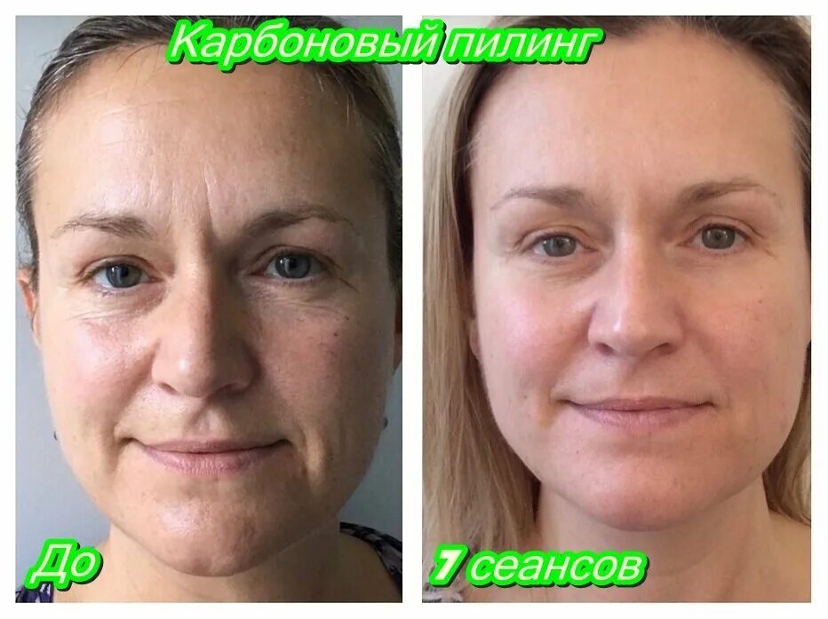 Миофасциальный массаж лица фото до и после Udalenietattoo42, cosmetology, Kemerovo, Lenina Avenue, 160 - Yandex Maps