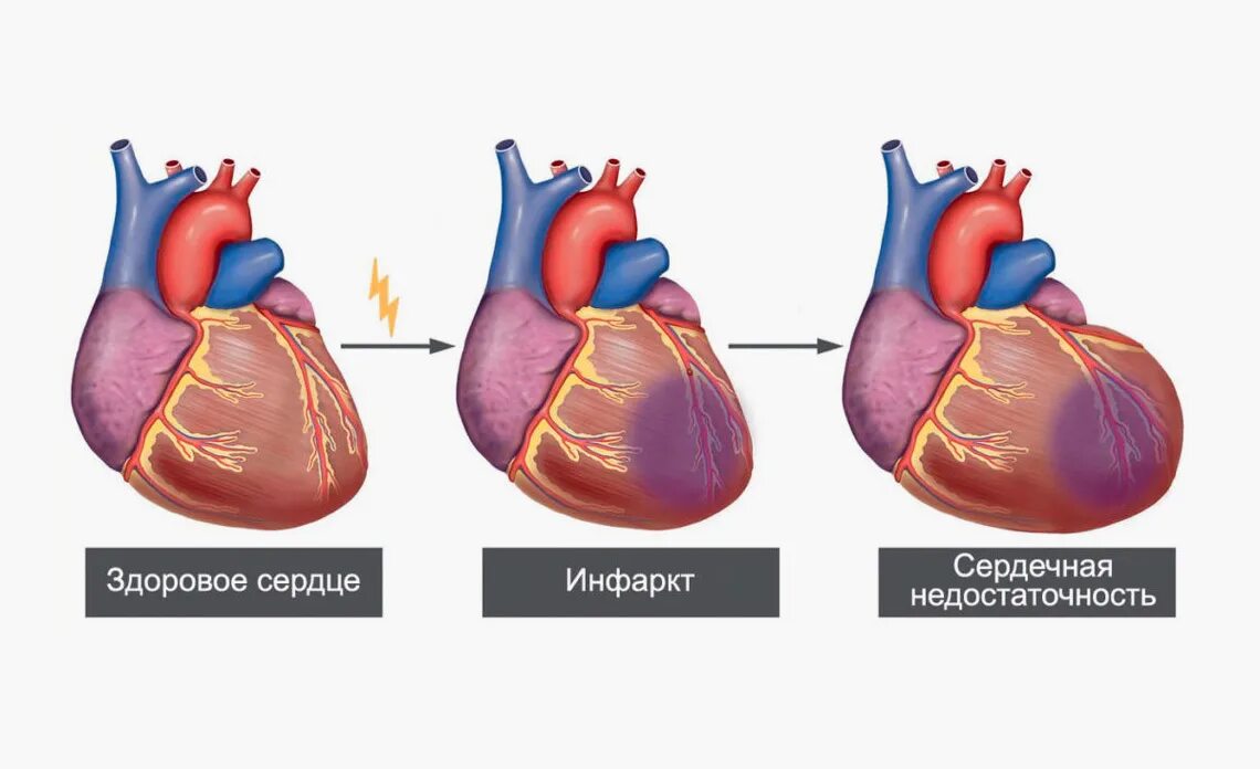 Миокарда сердца фото Половина случаев инфарктов миокарда остаётся незамеченной - Национальная бариатр