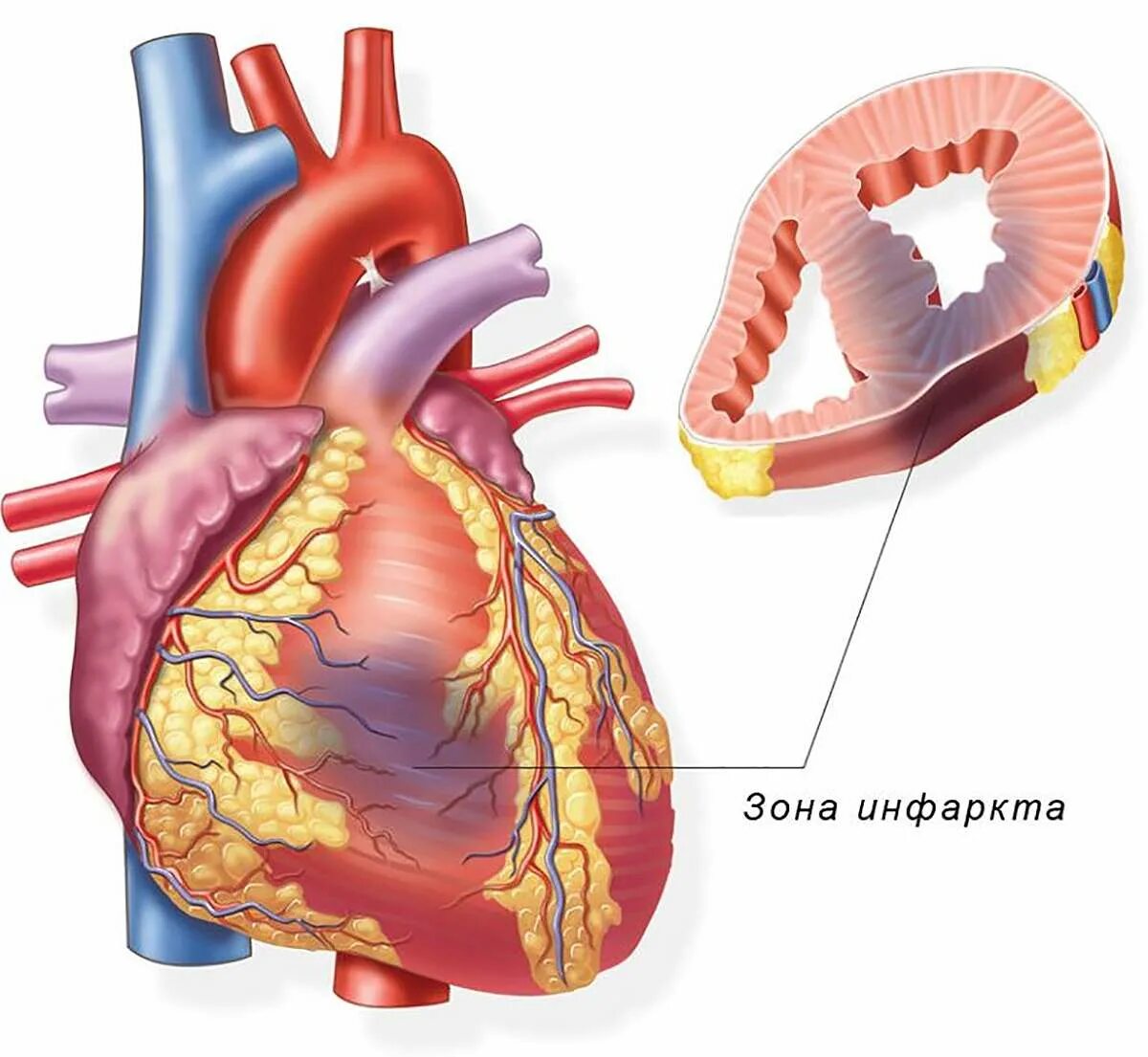 Миокарда сердца фото Простыми словами. Инфаркт миокарда