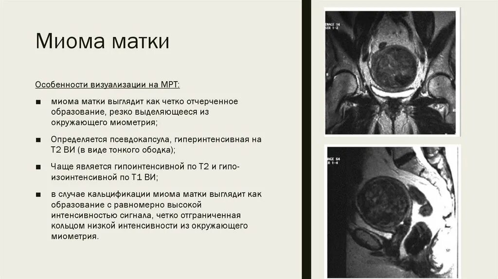 Миома матки что это такое фото Картинки АНАМНЕЗ МИОМЫ МАТКИ