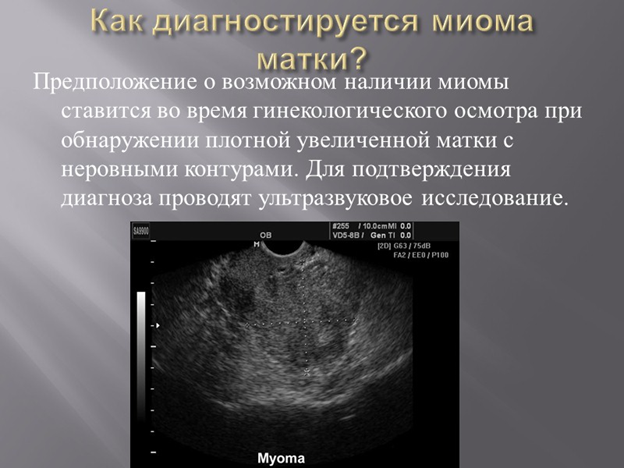 Миома матки что это такое фото Миома матки