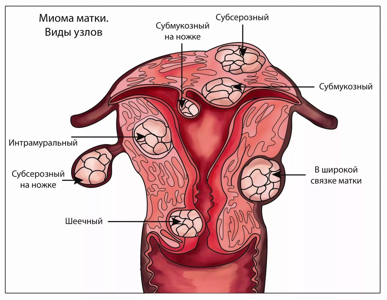 Миома матки что это такое фото Противозачаточные таблетки при миоме матки: виды и эффективность