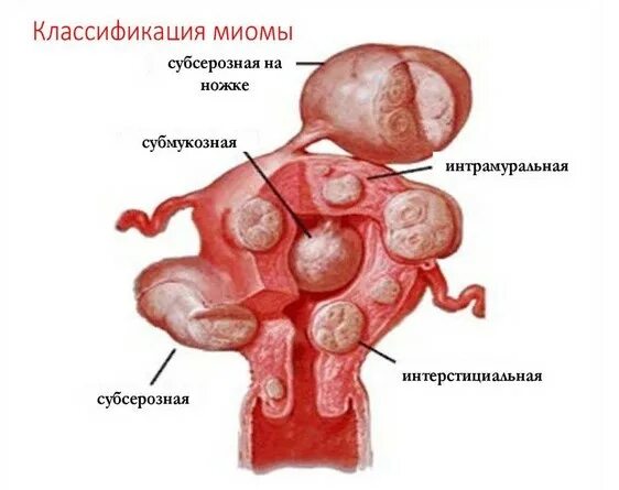 Миома матки что это такое фото Миома матки на КТ - на какой день цикла делают КТ при миоме матки