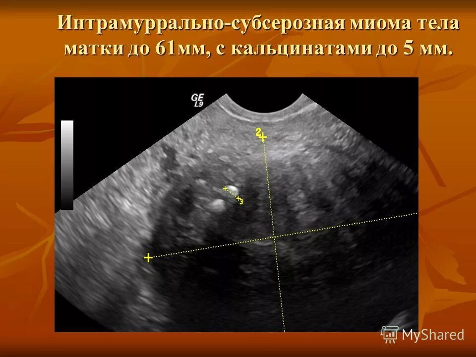 Миома матки что это такое фото Узи удаление матки - найдено 85 картинок