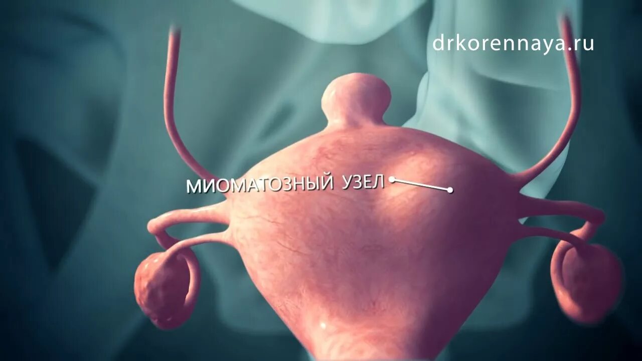 Миома матки что это такое фото Миома матки. Хирургическое лечение - YouTube