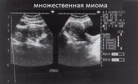 Миома матки что это такое фото Субсерозная миома матки: что это, лечение, симптомы и признаки eraminerals.ru