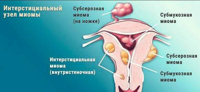 Миома матки симптомы фото Миома клинические рекомендации 2023 - найдено 84 картинок