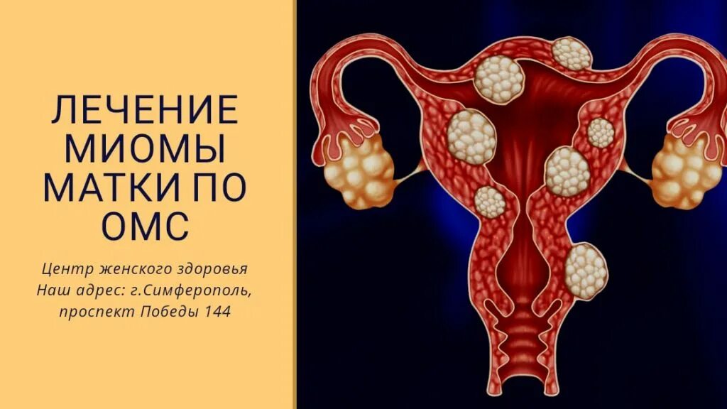 Миома матки симптомы фото Лечение миомы в Симферополе и Крыму - Клиника Этель