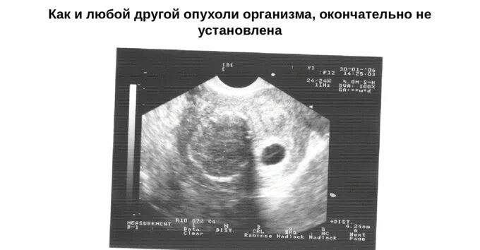Миома матки симптомы фото Аденомиоз