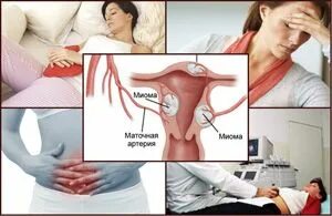 Миома матки симптомы фото Диагностика и лечение миомы при беременности Врачи