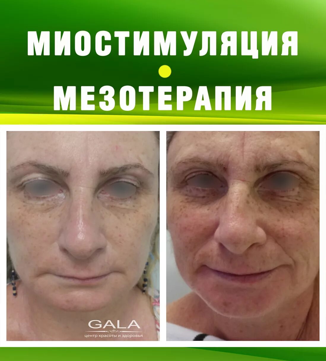 Миостимуляция лица отзывы фото до и после Pin by Diana on $123 Movie posters, Poster, Incoming call screenshot