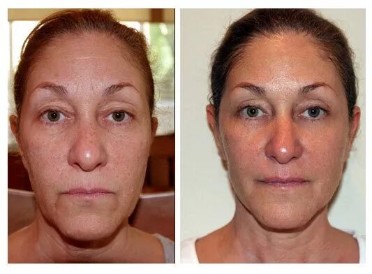 Миостимуляция лица отзывы фото до и после Pin on face exercises before and after