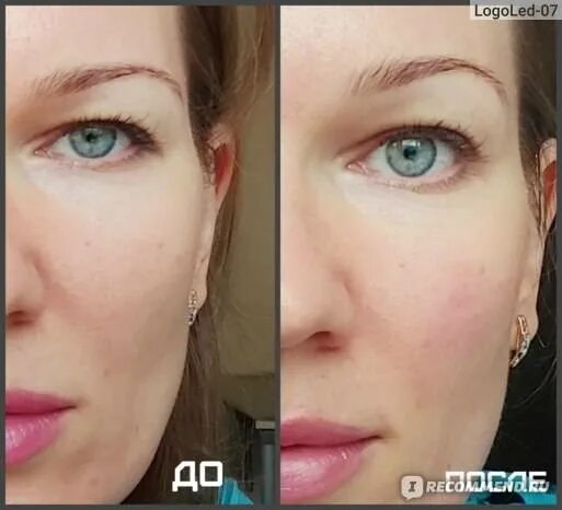 Миостимуляция лица отзывы фото до и после Все о миостимуляции лица: плюсы и минусы процедуры, отзывы, фото до и после