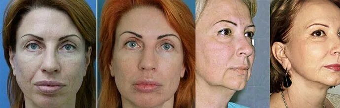 Миостимуляция лица отзывы фото до и после Миостимуляция лица, понятие, показания, ограничения, методика проведения. Аппара