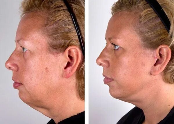 Миостимуляция лица отзывы фото до и после Pin on Using Face Acupressure And Facial Toning