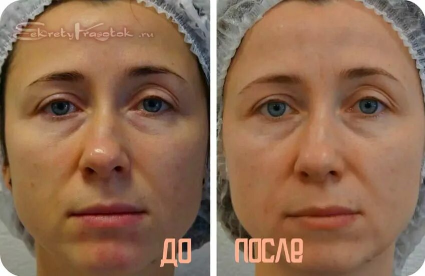 Миостимуляция лица отзывы фото до и после Миостимуляция мышц лица: что это такое и поможет ли сохранить молодость? - Секре