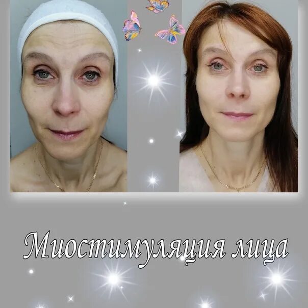 Миостимуляция на лице фото до и после Все о миостимуляции лица: плюсы и минусы процедуры, отзывы, фото до и после