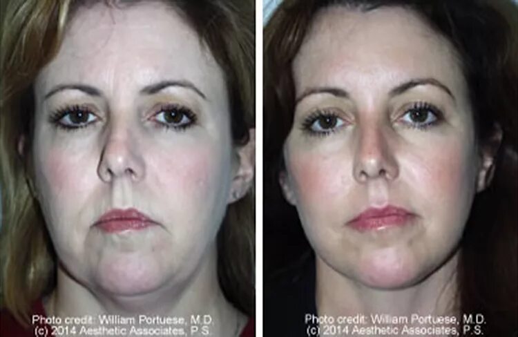 Миостимуляция на лице фото до и после Best Brow Lift Surgeon in Seattle & Bellevue Washington