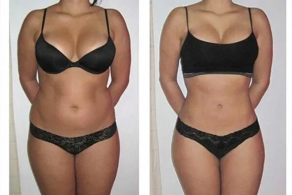 Миостимуляция тела отзывы фото до и после #AntiAgingReviews #CelluliteTreatmentAtlanta Abdominoplastia, Endurecimento da p
