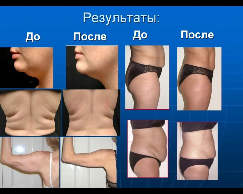 Миостимуляция тела отзывы фото до и после Теория Лазерный липолиз Центр инновационного косметологического оборудования Met