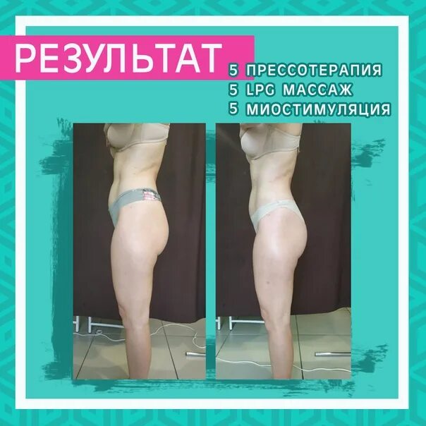 Миостимуляция тела отзывы фото до и после Lpg массаж прессотерапия