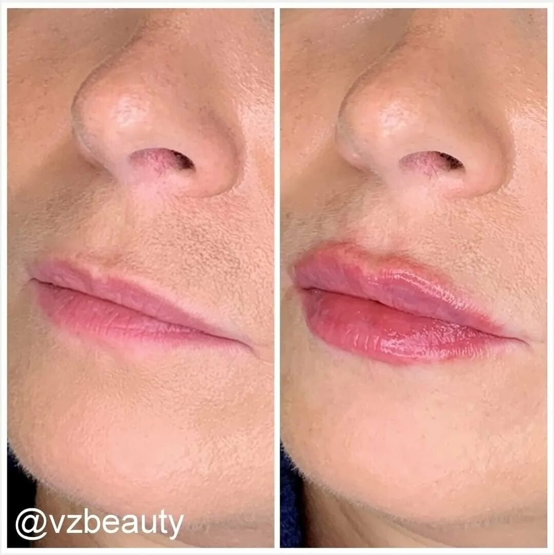 Мл в губы до и после фото Носогубные складки - vzbeauty.ru
