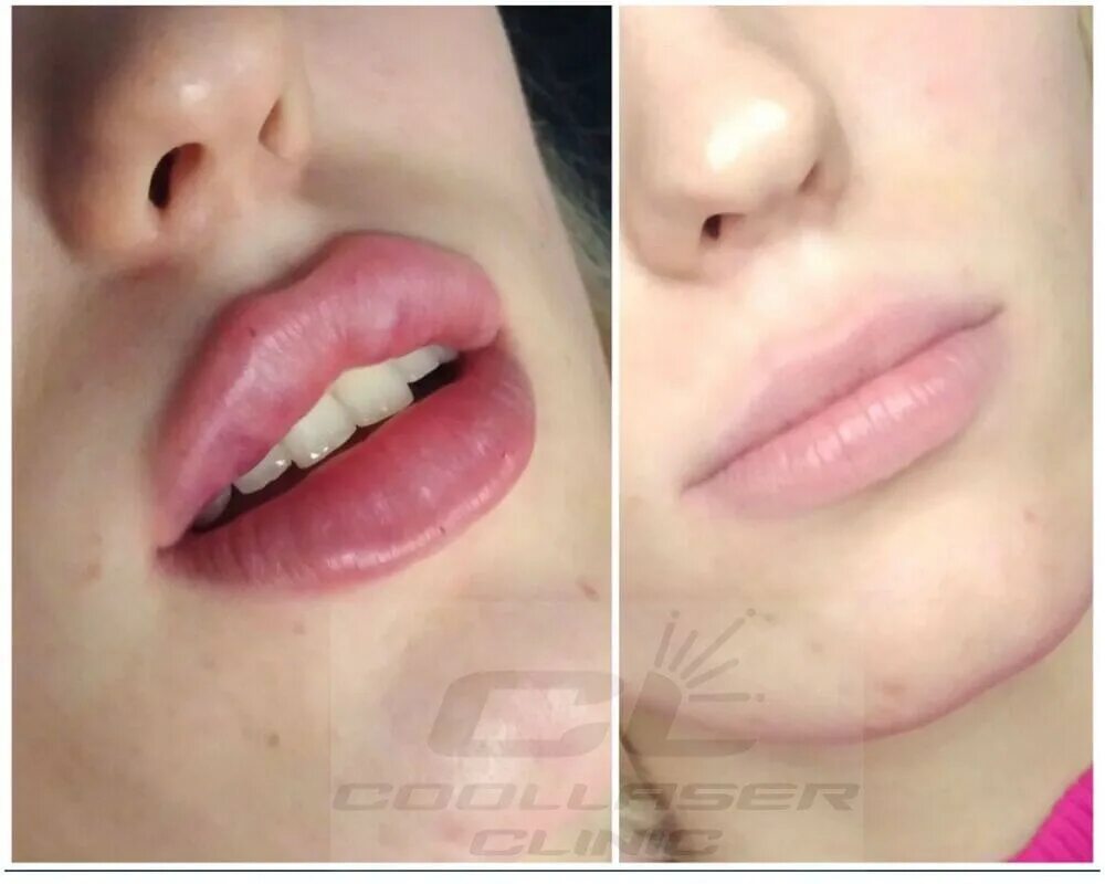 Мл в губы до и после фото Увеличение губ: гайд года - Coolaser Clinic