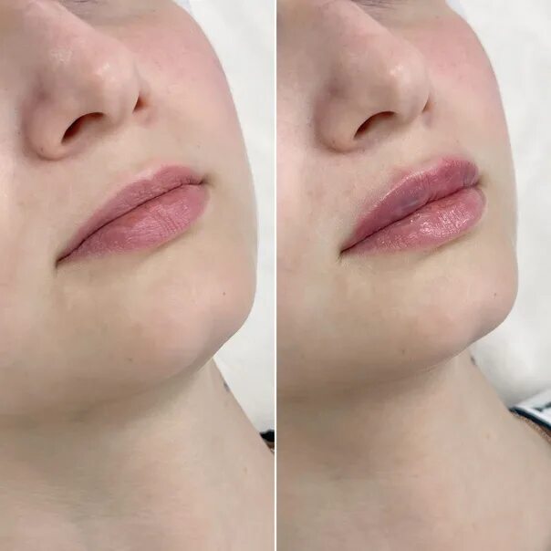 Мл в губы до и после фото #до_после_mosinaclinic Баунти - это ерунда. Любимые губы - вот райское наслажден