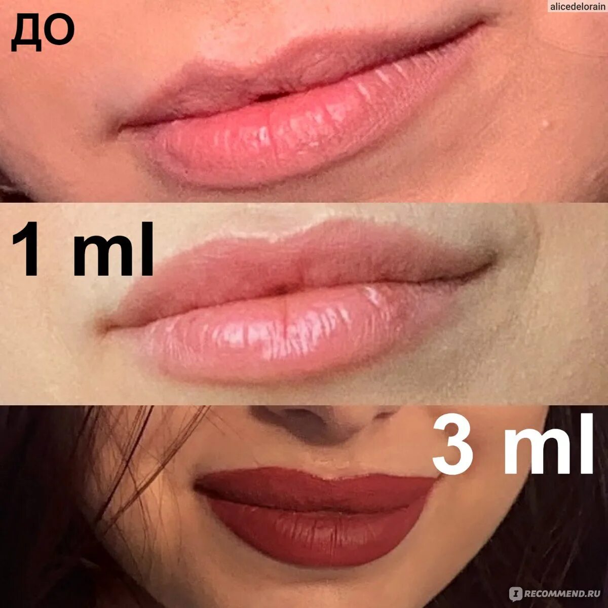 Мл в губы до и после фото Контурная пластика препаратом Stylage - "3 ML за 3 месяца в губы! Я стала уткой?