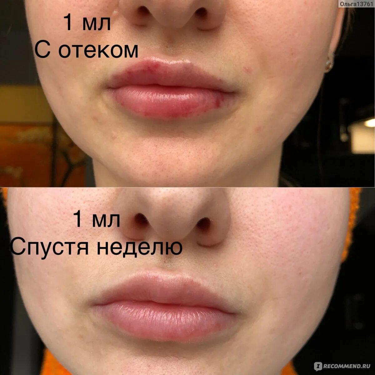 Мл в губы до и после фото Увеличение / Аугментация губ с помощью препарата гиалуроновой кислоты - "Для тех