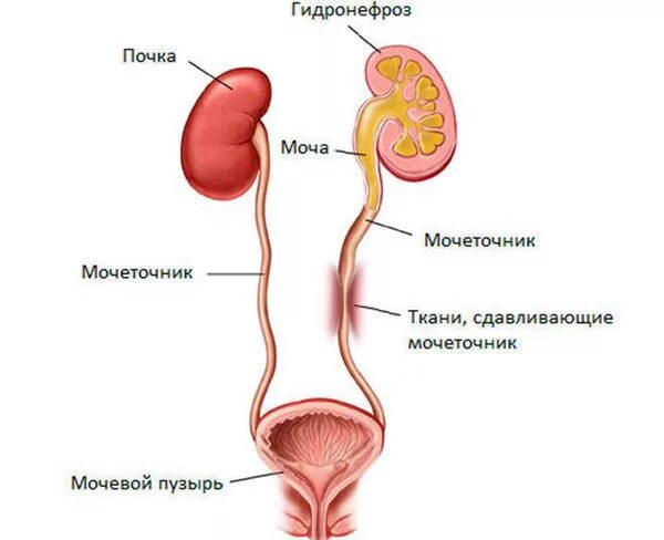 Мочеточник у мужчин строение фото анатомия Гидронефроз почек: что это такое, симптомы, стадии и лечение в статье уролога Га