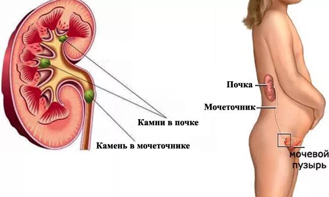 Мочеточники у женщин расположение фото воспаление симптомы Камни в почках симптомы у женщин при беременности - Здоровый ребенок