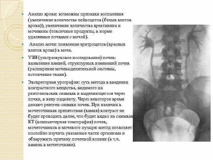 Мочеточники у женщин расположение фото воспаление симптомы Мочеточник симптомы