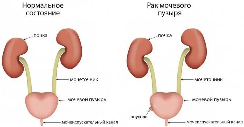 Мочеточники у женщин расположение фото воспаление симптомы Воспаление мочеточника у женщин и мужчин: симптомы, лечение