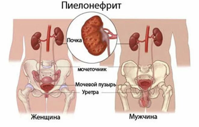 Мочеточники у женщин расположение фото воспаление симптомы Заболевания почек (Пиелонефрит) - ЕМЦ