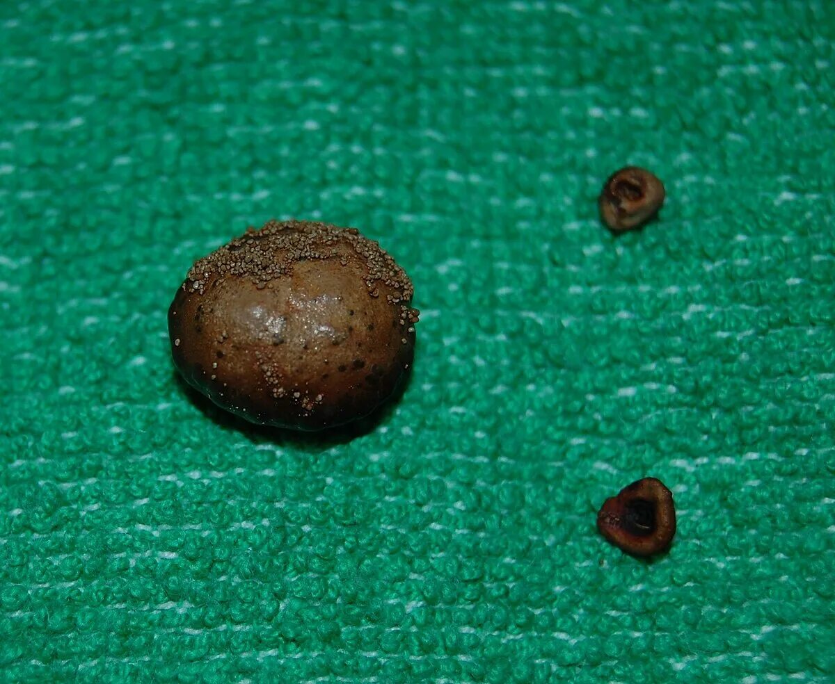Мочевой камень фото File:Bladder stones sharp.jpg - Wikimedia Commons