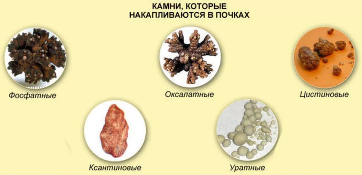 Мочевой камень фото На малой мочекаменной волне. Моя история, мои ошибки Пикабу