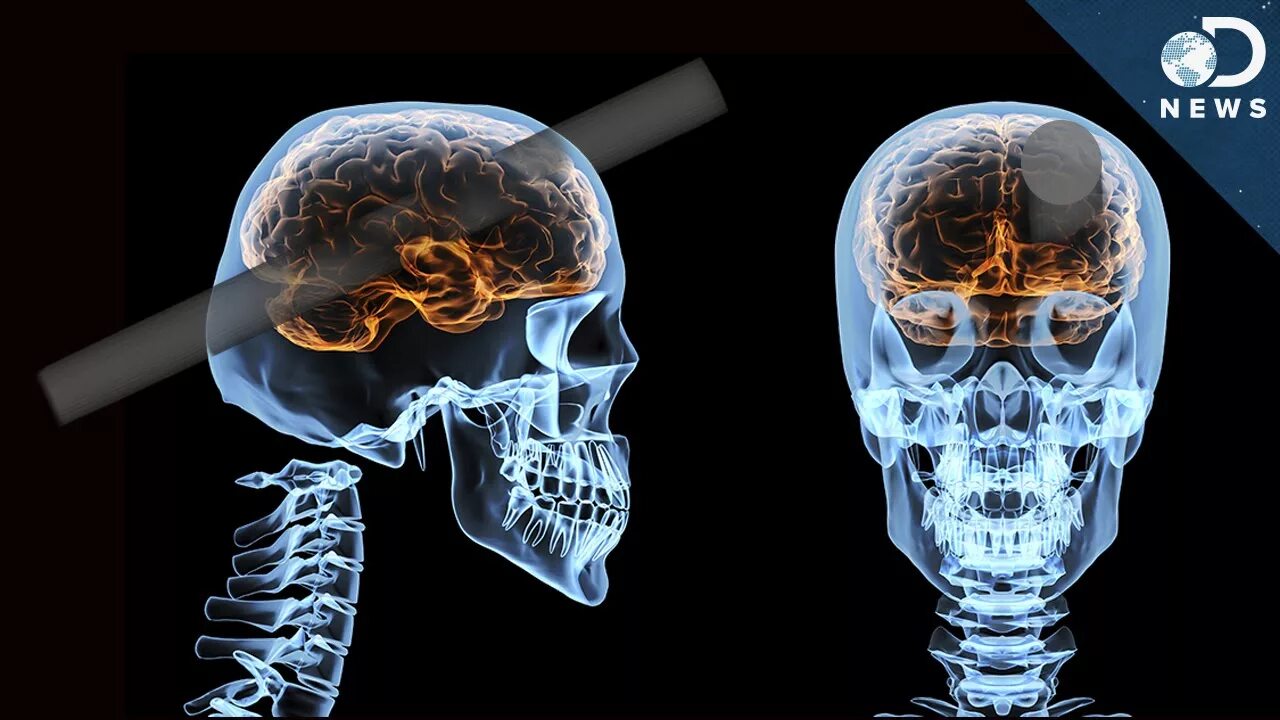 Мозг в черепе фото What Could Happen After A Brain Injury? - YouTube