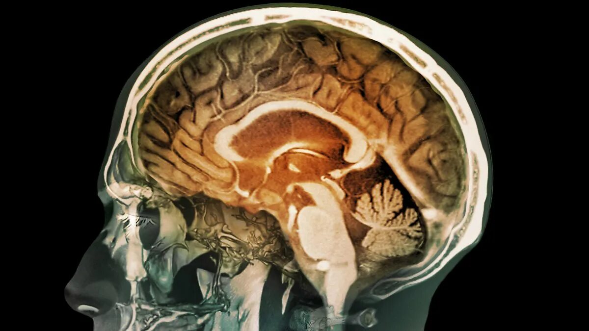Мозг в черепе фото BBC World Service - Newshour, Brain Cancer Vaccine Hope