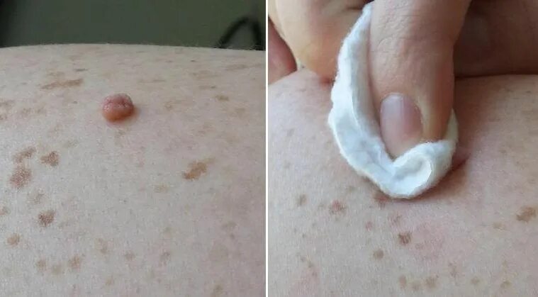 Нарост на горле внутри как папиллома фото Pin on DIY health, external