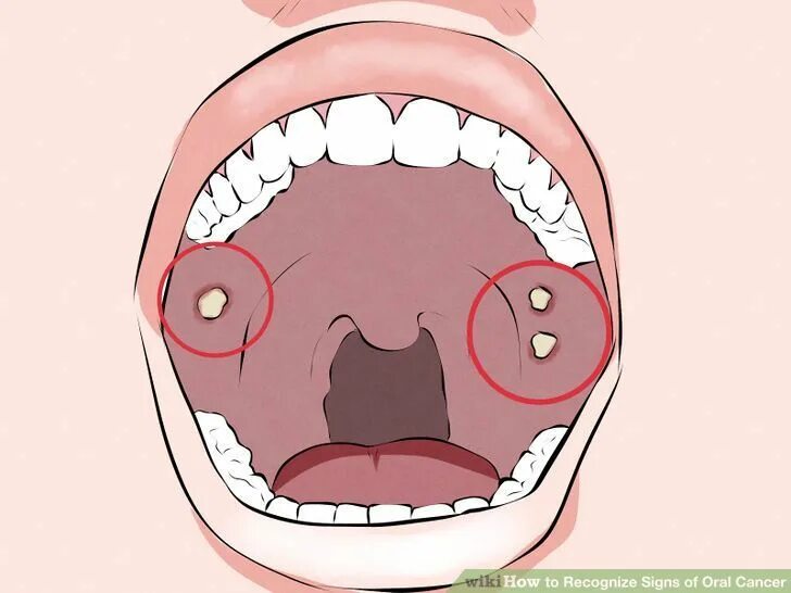 Нарост на горле внутри как папиллома фото Pin by Patient Friendly Dental on Best Dentist Bushwick Best dentist, Free inter