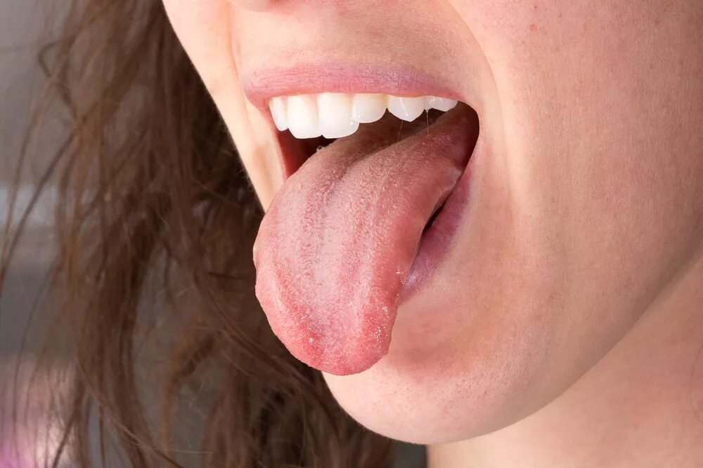 Нарост на горле внутри как папиллома фото PICOR DE LENGUA - Estudi Dental Barcelona