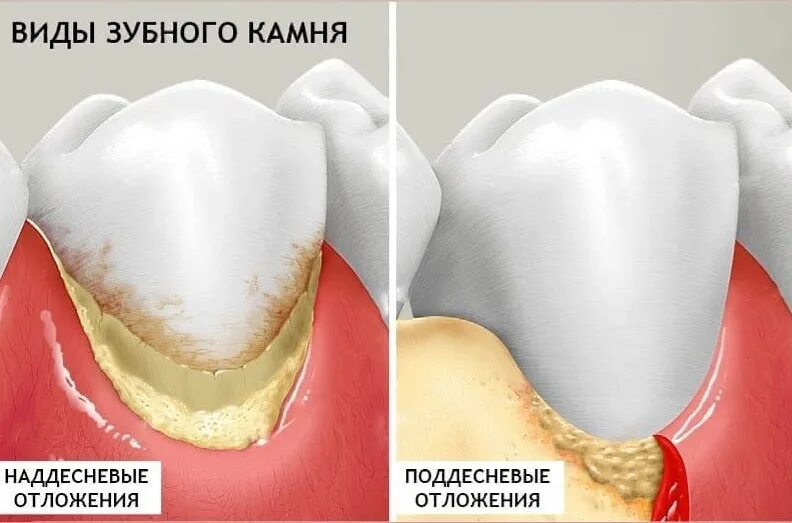 Нарост на зубах фото Зубной камень: нужно ли удалять? Советы профессионалов Маэстро-Дент