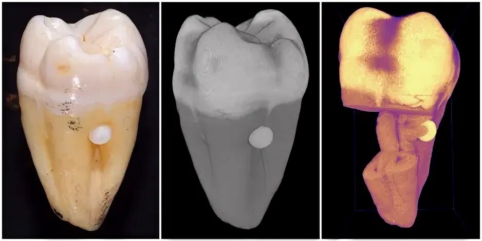 Нарост на зубах фото How enamel pearl looks in vivo, on xray and dental CT scan Dentistry, Dental hyg