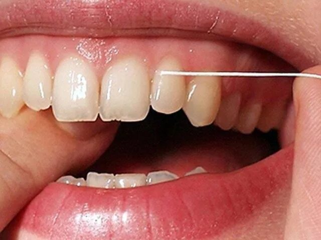 Нарост на зубах фото Профессиональная гигиена полости рта: рекомендации :: SYL.ru