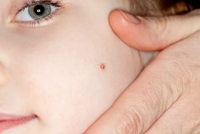 Наросты на лице фото Verruche: rimedi naturali per curare piedi, mani e genitali