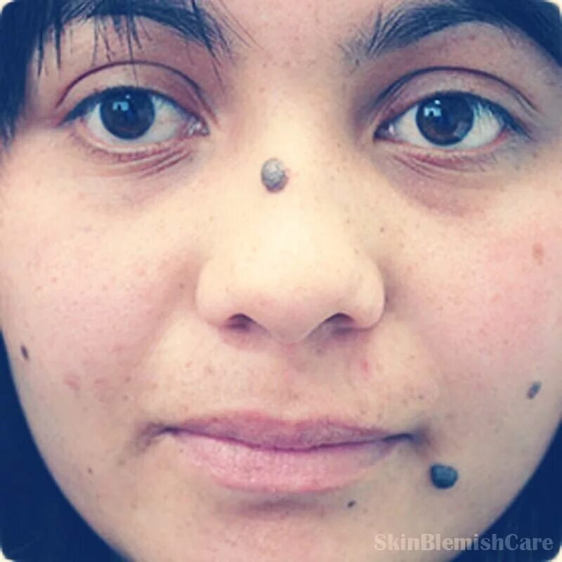 Наросты на лице фото How To Get Rid And Fade A Mole In Just Days! 7 places
