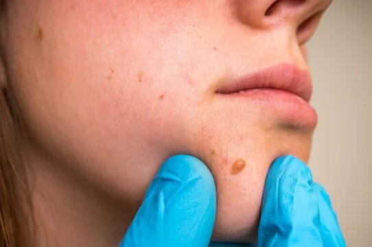 Наросты на лице фото Skin Cancer Surgery Зображення - огляд 5,128 Стокові фото, векторні зображення й